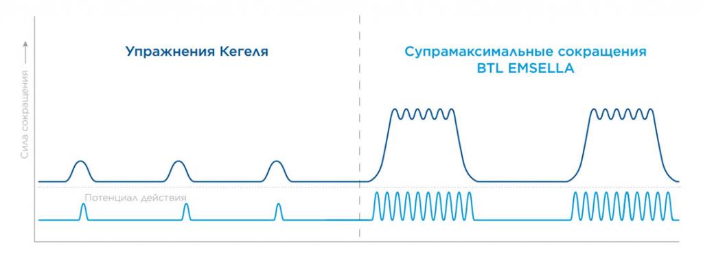 Аппарат BTL EmSella для тренировок мышц тазового дна